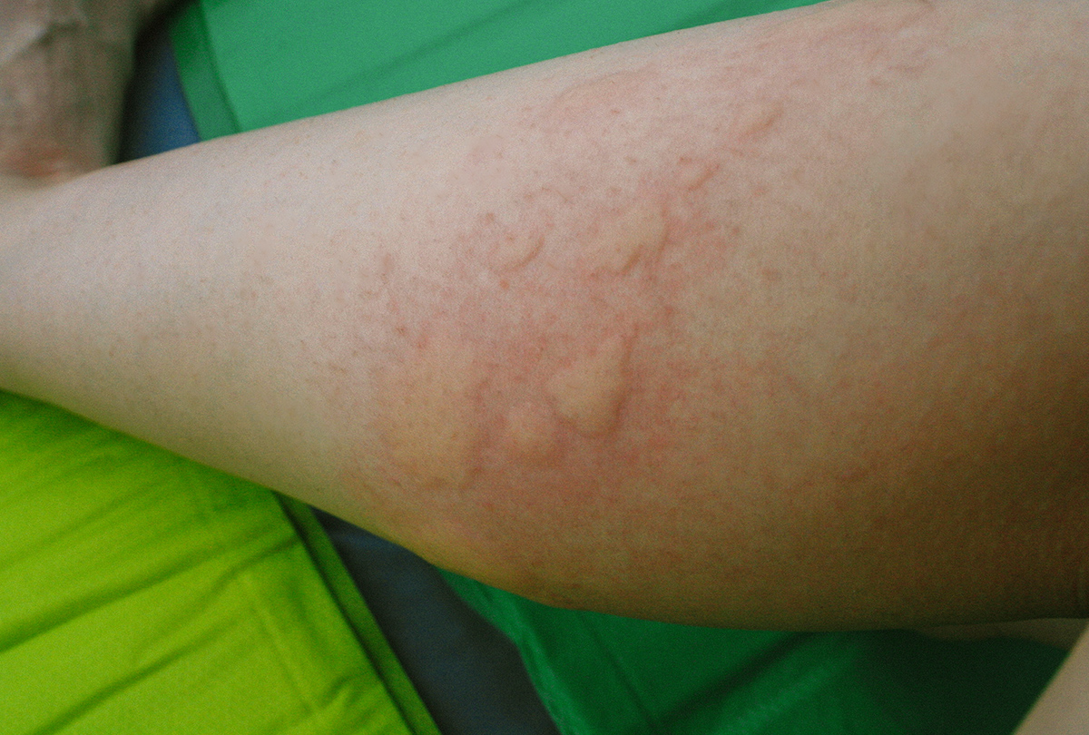 A woman's leg covered in swollen mosquito bites.